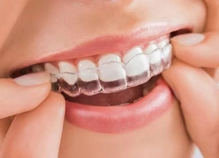 Loại mắc cài nào tốt nhất để niềng răng?