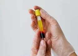 Người phụ nữ bất ngờ khi biết lý do mỡ máu tăng dồn dập