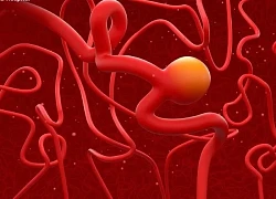 Phình động mạch não có nguy hiểm không?
