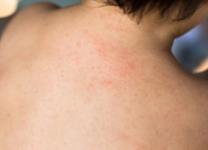 Cách nhận biết và xử lý sốt phát ban ở trẻ sơ sinh