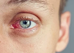 Dấu hiệu ở mắt cảnh báo thận có vấn đề, cần đi khám sớm
