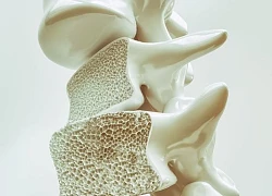 Loãng xương: Ai cần đo mật độ xương và cách phòng ngừa hiệu quả?