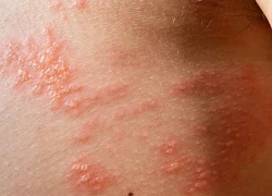 Phân biệt triệu chứng giời leo và bệnh chàm