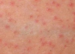 Viêm nang lông ở trẻ có nguy hiểm không?