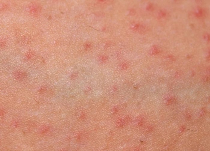Viêm nang lông ở trẻ có nguy hiểm không?