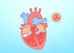 Biến chứng nguy hiểm hẹp van động mạch chủ và cách điều trị