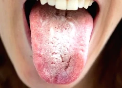 Nguyên nhân gây bệnh ung thư đáng sợ nhất có thể nằm trong miệng