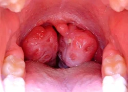 Những thói quen âm thầm dẫn tới ung thư vòm họng