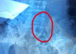 Vụ cô gái nuốt kim băng đang mở khi ăn ốc: Chính chủ nói rõ lý do nuốt vật nhọn mà không hay biết