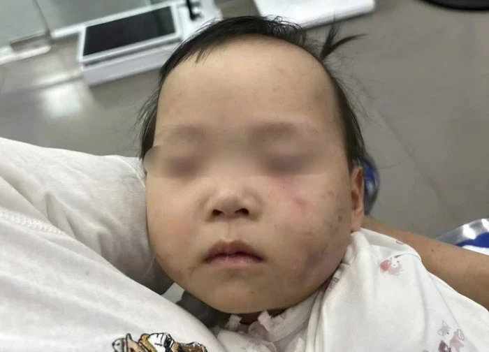 Bé gái 1 tuổi bị bầm tím mặt khi gửi nhà trẻ ở Bắc Ninh: Công an tạm giữ cô giáo