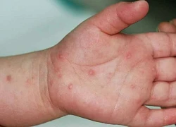 Dấu hiệu nhận biết bệnh tay chân miệng