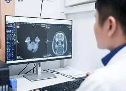 Tắc nghẽn hoàn toàn động mạch cảnh, nguy cơ đột quỵ dù không có triệu chứng báo trước