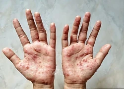 WHO dỡ bỏ tình trạng khẩn cấp toàn cầu đối với bệnh đậu mùa khỉ