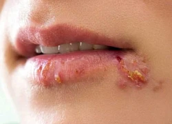 Vì sao zona thường tái phát và gây đau kéo dài?