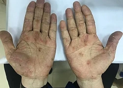 Cẩn trọng với bệnh nhiễm ấu trùng giun đũa chó, mèo