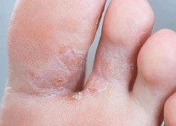 Nước ăn chân - Dùng thuốc và các phương pháp chữa trị tại nhà