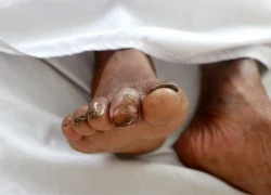 Đắk Lắk: Một người tử vong do nhiễm 'vi khuẩn ăn thịt người'