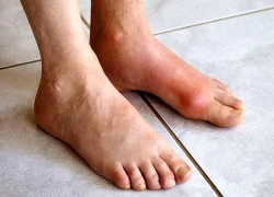 Gia tăng người trẻ đau khớp do gout, bác sĩ cảnh báo dấu hiệu cần chú ý
