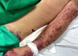 Ăn lòng lợn, nem chua, thanh niên 33 tuổi nhiễm bệnh nguy hiểm