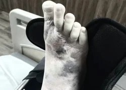 Bàn chân suýt mất chỉ vì vết xước tưởng vô hại