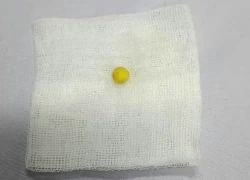 Cứu sống bệnh nhi 8 tuổi bị hóc dị vật đường thở