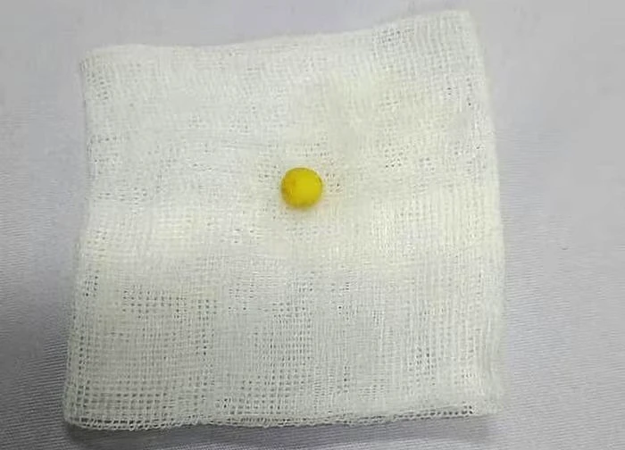 Cứu sống bệnh nhi 8 tuổi bị hóc dị vật đường thở