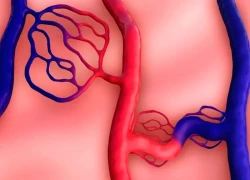 Dị dạng mạch máu não có nguy hiểm không?