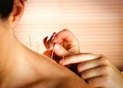 Nghiên cứu Mỹ khẳng định châm cứu hiệu quả với chứng đau lưng mạn tính