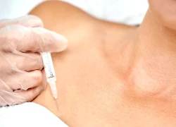 Sau nâng ngực, người phụ nữ hốt hoảng khi bác sĩ hút ra hơn 2 lít dịch viêm