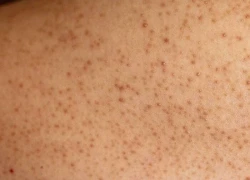 Điều trị viêm nang lông tại nhà bằng thuốc và các nguyên liệu tự nhiên