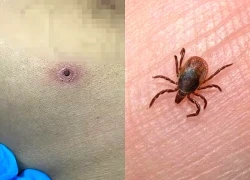 Người đàn ông bị sốt kéo dài, suy hô hấp nặng, rối loạn đông máu do sốt mò