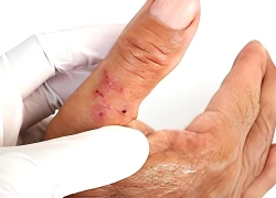 Triệu chứng viêm nội tâm mạc nhiễm trùng
