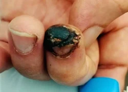 Vì sao uốn ván nguy hiểm?