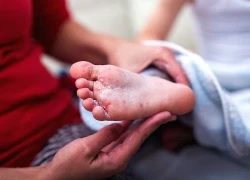 Vì sao trẻ mắc tay chân miệng nhiều lần?