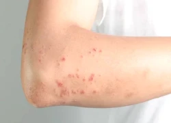 Triệu chứng mơ hồ dễ bị bỏ qua của bệnh sán dây nhỏ