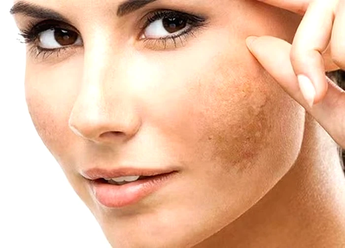 Uống gì để đẹp da, giảm nám cho phụ nữ sau tuổi 30?