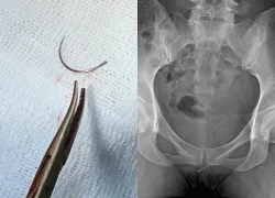 Kim khâu gãy nằm 11 năm trong tầng sinh môn của người phụ nữ