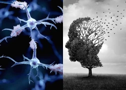 Liệu pháp siêu âm và hy vọng mới trong nghiên cứu Alzheimer