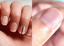 Móng tay nổi sọc dọc, cảnh báo dấu hiệu bất thường vấn đề sức khỏe