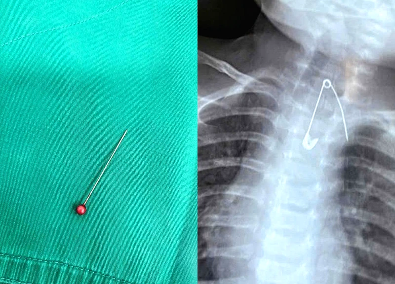 Giành lại sự sống cho bé 13 tháng tuổi mắc kim ghim trong phế quản