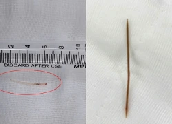 Bệnh viện ở TPHCM liên tục tiếp nhận các ca "nuốt nhầm" que tăm, xương cá