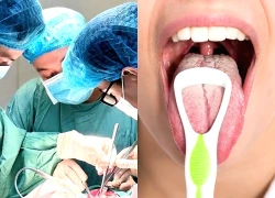 Chủ quan chẩn đoán lành tính, vết loét lưỡi kéo dài tiến triển thành ung thư