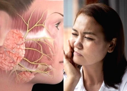 Rét đậm, rét hại làm gia tăng nguy cơ liệt dây thần kinh số 7