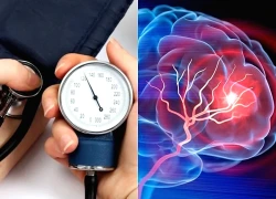 Sau cơn thiếu máu não thoáng qua, 72 giờ đầu cần làm gì để tránh đột quỵ não?