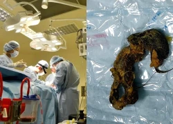 TP.HCM: Bé gái 9 tuổi bị tắc ruột do thói quen 'ăn tóc'