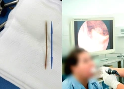 Cảnh báo nguy hiểm từ những ca hóc dị vật