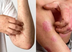 Cảnh giác các bệnh da thường gặp trong mùa lạnh