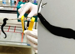 Đỉa dài 10 cm sống ký sinh trong mũi người bệnh
