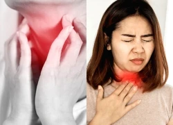 Ngoài trào ngược dạ dày - thực quản, đâu là nguyên nhân gây viêm họng mạn tính?