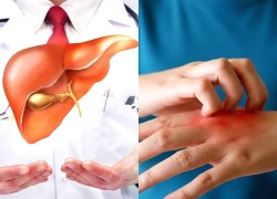 6 dấu hiệu rõ ràng cho thấy gan đang nhiễm mỡ